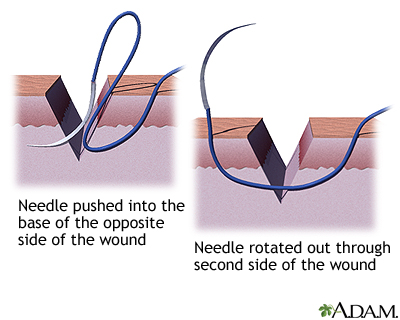 Sewing a wound closed, part 3