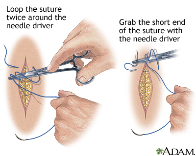 Sewing a wound closed, part 5