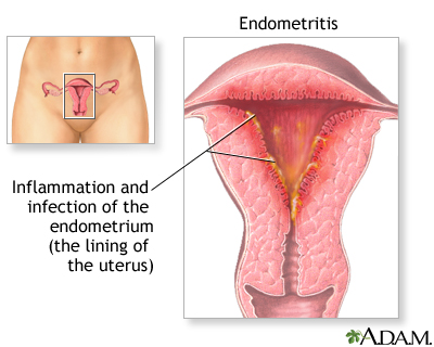 Endometriosis  Loma Linda University Center for Fertility
