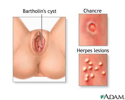 yeast infection bumps women