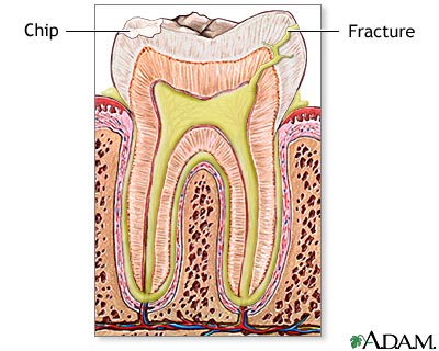 Fractured tooth