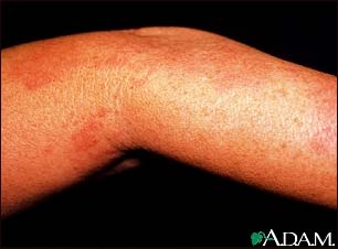 Herpes zoster (shingles) on the arm