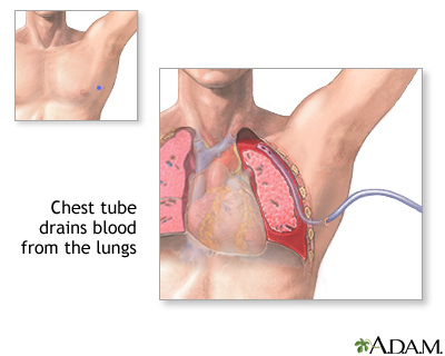 Chest Tube Insertion Series Lima Memorial Health System