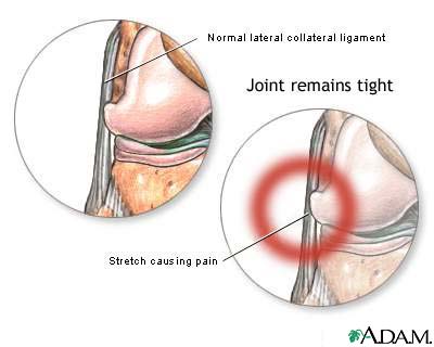 Lateral collateral ligament pain