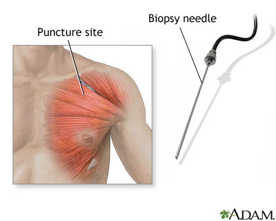 biopsy biopsia muscular musculares galerii distrofia tissue tejido