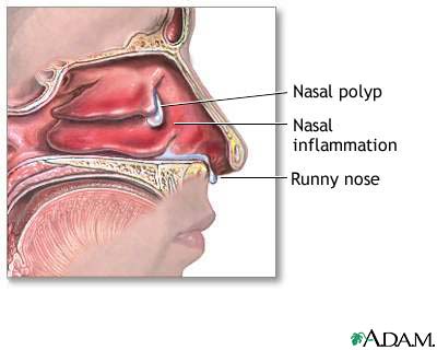 nasal polyps cancer