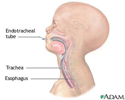 Endotracheal intubation