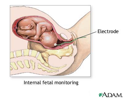 Internal fetal monitoring