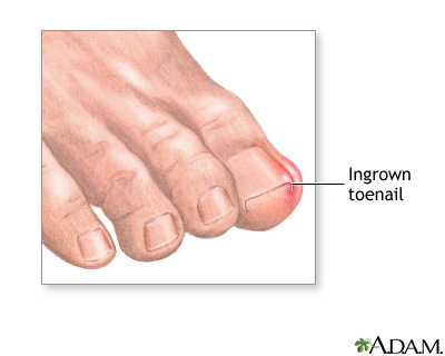 How to Ease the Pain of Ingrown Toenails, Pt. 2 - Palmetto State