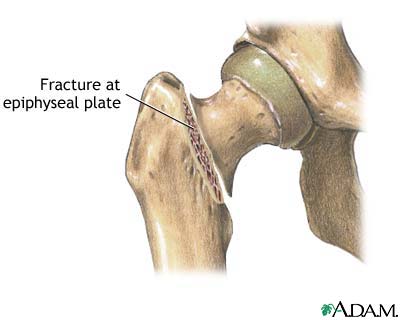 Femoral fracture