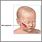 Hemangioma excision - series